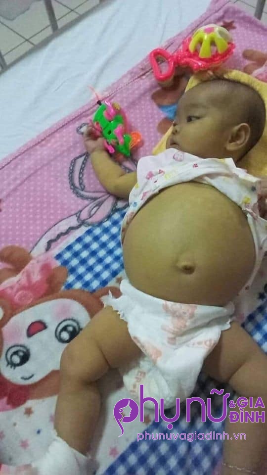 55 triệu đồng đến với bé gái 8 tháng tuổi không có túi mật, bụng chực nổ tung vì căn bệnh hiểm nghèo - Ảnh 1 55 triệu đồng đến với bé gái 8 tháng tuổi không có túi mật, bụng chực nổ tung vì căn bệnh hiểm nghèo - Ảnh 1