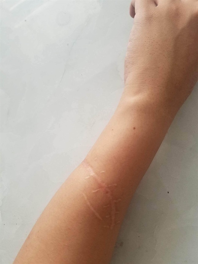 Bị chém đứt gân tay, chàng trai bình phục một cách kỳ diệu sau 45 ngày nhờ tập ảo thuật - Ảnh 3 Bị chém đứt gân tay, chàng trai bình phục một cách kỳ diệu sau 45 ngày nhờ tập ảo thuật - Ảnh 3