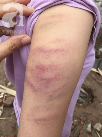 Hà Nội: Cô giáo đánh bầm tím tay học sinh lớp 5 vì không làm bài tập về nhà - Ảnh 3 Hà Nội: Cô giáo đánh bầm tím tay học sinh lớp 5 vì không làm bài tập về nhà - Ảnh 3