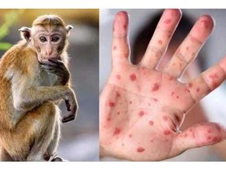 Việt Nam sẽ chủ động, nghiên cứu sản xuất thuốc điều trị bệnh đậu mùa khỉ